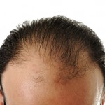 calvizie, centro tricologico