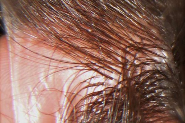 Protesi capelli standard uomo