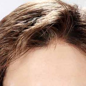 Calvizie femminile Calvizie femminile