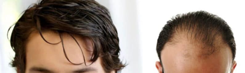 Protesi Capelli Gradual